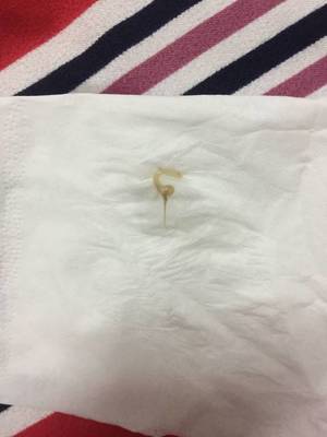 怀孕了白带会变多吗