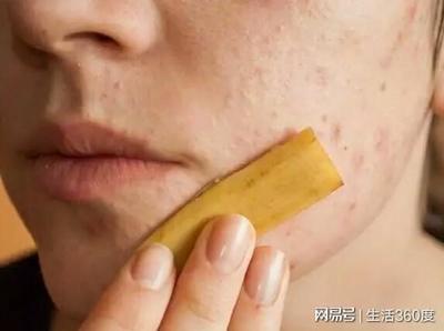 香蕉皮放痘痘上可以吗