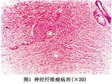 神经纤维瘤