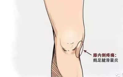 膝关节滑囊炎怎么治疗