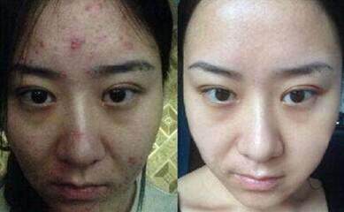 怎么根治痘痘的方法