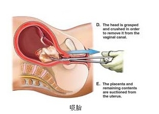 阳痿可以怀孕吗