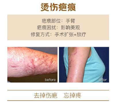 治疗疤痕最好的方法