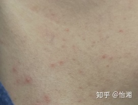 痤疮应该怎么治疗