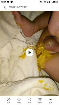 怎么让宝宝拉粑粑