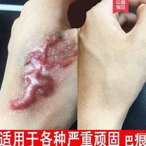 红色痘痘疤痕怎么消除