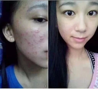 长痘痘变好的帖子