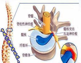 腰间盘突出压迫神经怎么治疗