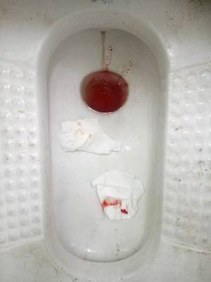 小便出血是怎么回事男