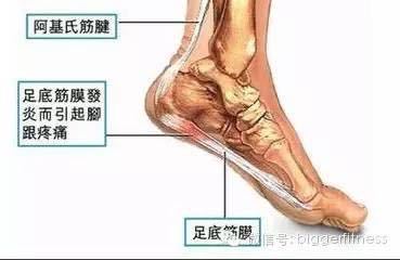 足底筋膜炎怎么治疗能除根