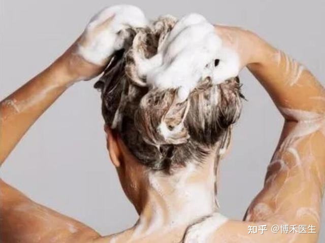 头皮炎怎么治疗