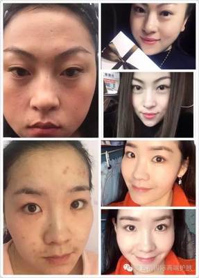光打水光针长痘痘