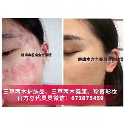 健康水 痘痘