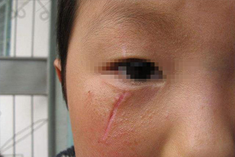 指甲疤痕如何去除