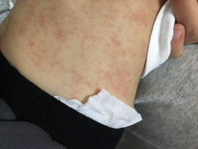 8个月宝宝身上长了很多红点