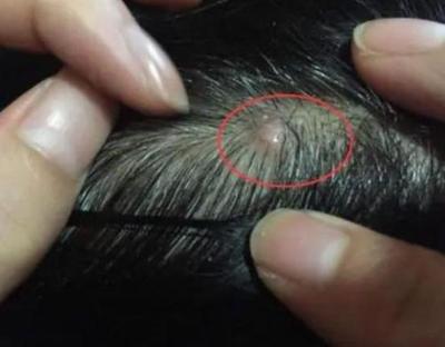 痘痘脓水挤不完