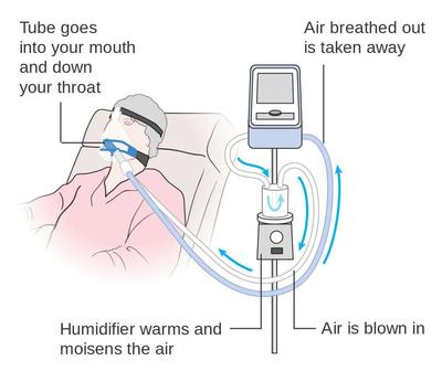 呼吸机总呼吸频率多少算危险