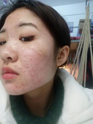 痘痘严重到快烂脸了