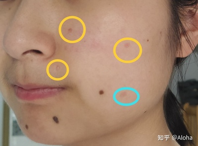 祛痣后的褐色印会消吗