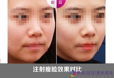 botox注射瘦脸效果