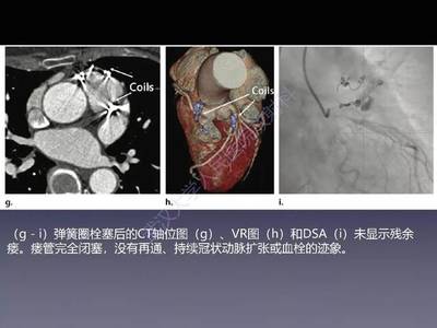 冠状动脉瘘怎么治疗