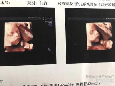四个月可以做四维彩超吗