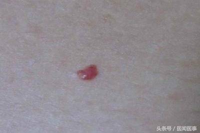 红痣是怎么回事