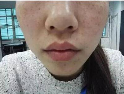 脸上突然长斑是怎么回事