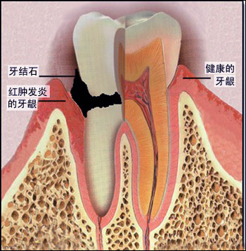 口腔出血是什么原因