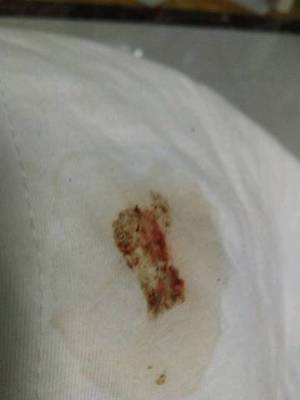 拉黑色粑粑是怎么回事