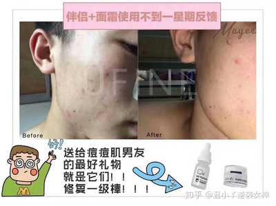 痘痘肌到底用不用面霜