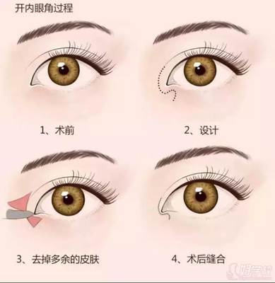 内眦赘皮双眼皮