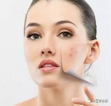 脸上痘印怎么快速消除