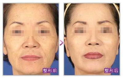鱼尾纹除皱方法