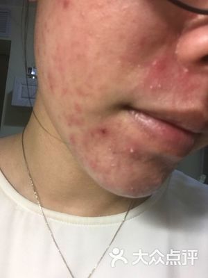 痘痘怎么消除江城皮肤可以