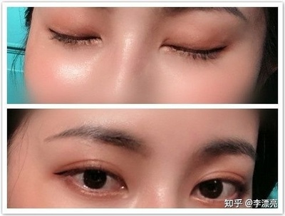 在切双眼皮多少价格