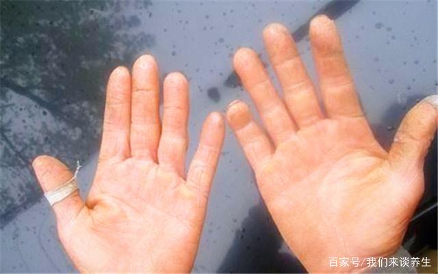 脚裂口子怎么治疗