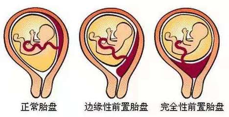 胎儿与胎盘的位置图片