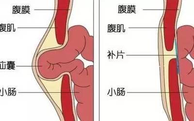 肚子疝气