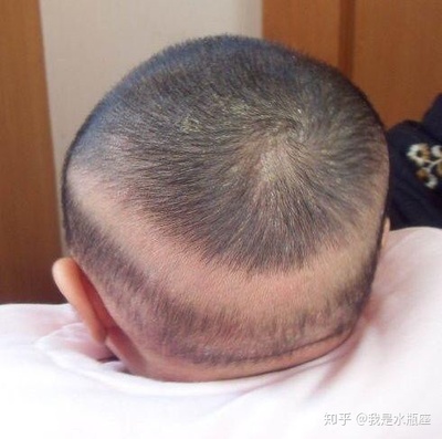 天天掉头发是怎么回事