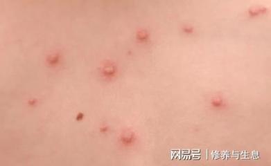 身上有扁平疣是怎么回事