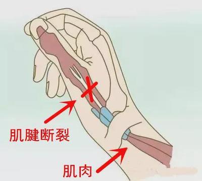 手指肌腱断裂工伤十级