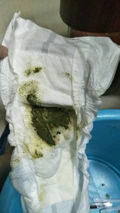 大便墨绿色是怎么回事