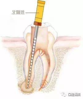 一颗牙根管要多少钱