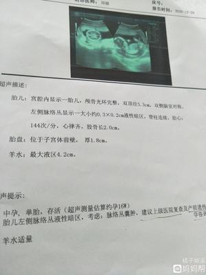 胎儿左侧脉络丛囊肿