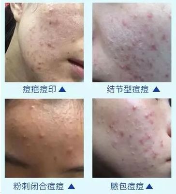 隆起的大痘痘