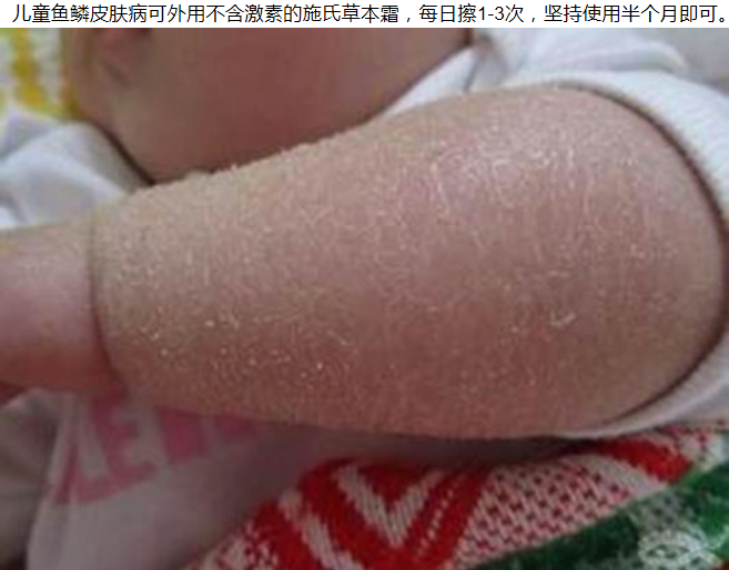 宝宝鱼鳞皮肤病图片
