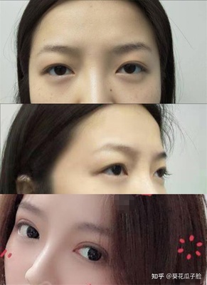 做双眼皮的形状