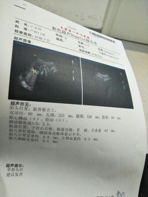 侧脑室宽说明胎儿聪明