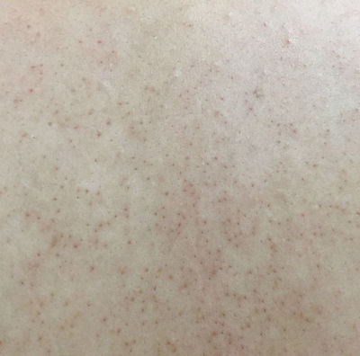 后背毛孔密密麻麻黑点